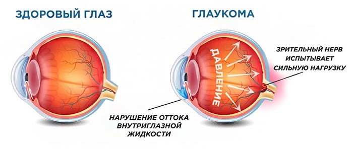 Глаукома Глаз Фото